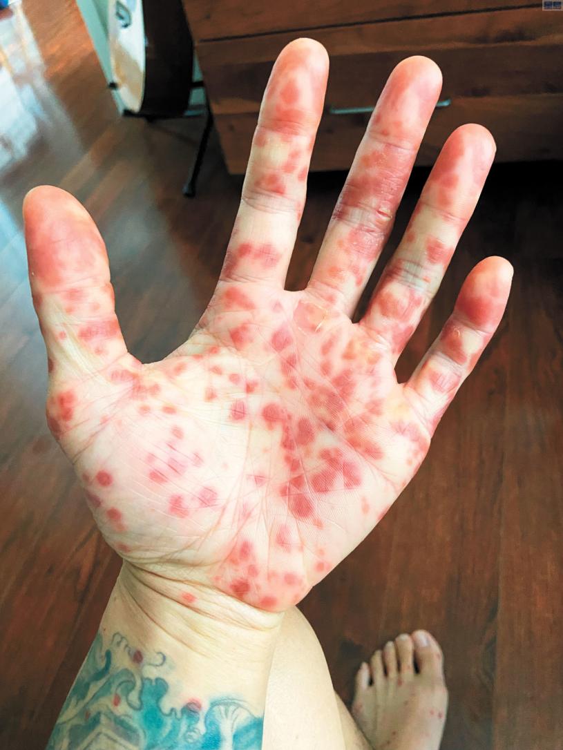 華裔猴痘病患現身說法醫生所知不多延誤診治| 星島日報